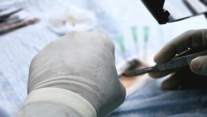 vasectomy side effects